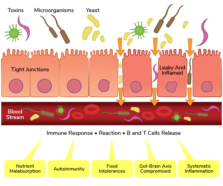 Diagram showing tight versus leaky gut junctions
